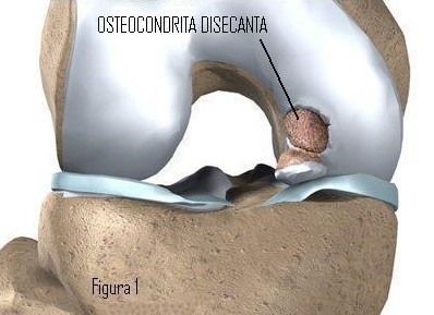 Osteocondrita Disecantă