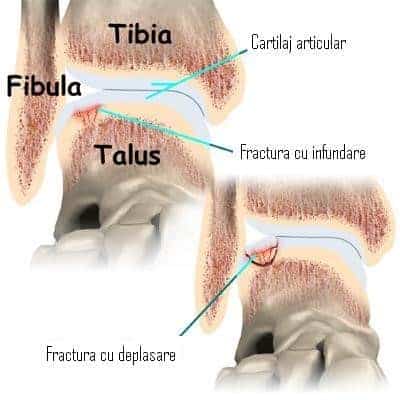 Osteocondrita Disecantă de Talus (OCDT)