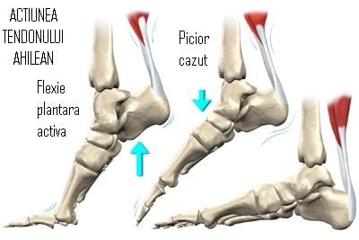 Ruptură Tendon Achile