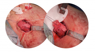 Surgical treatment