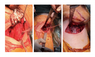 Surgical treatment