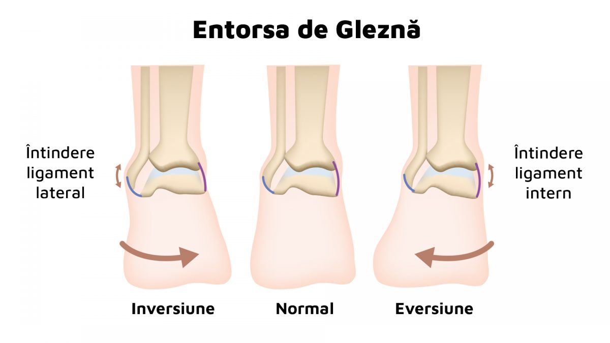 entorsa de glezna