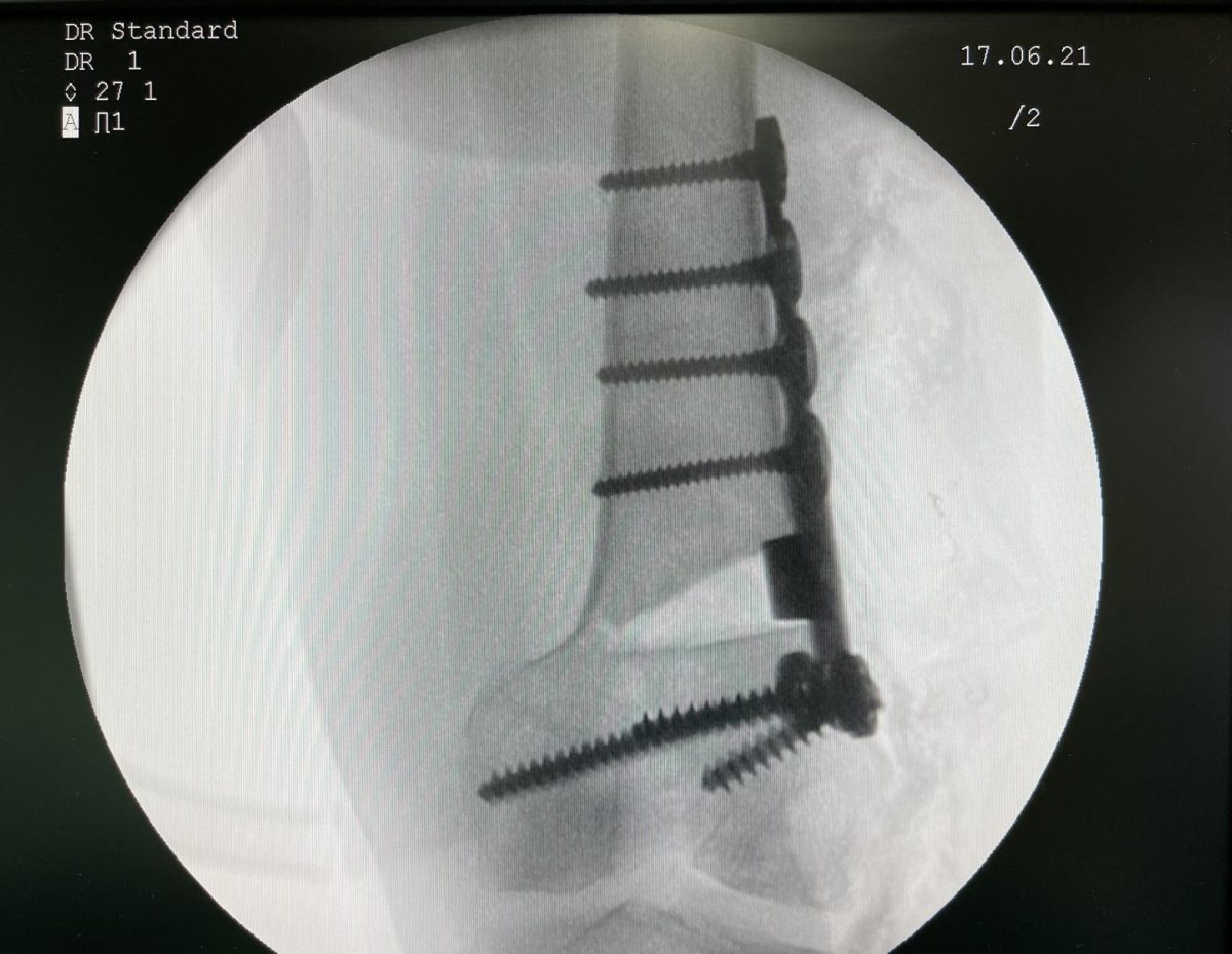 Femoral osteotomy