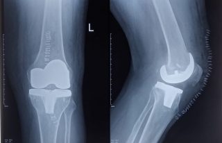 the knee replacement operation