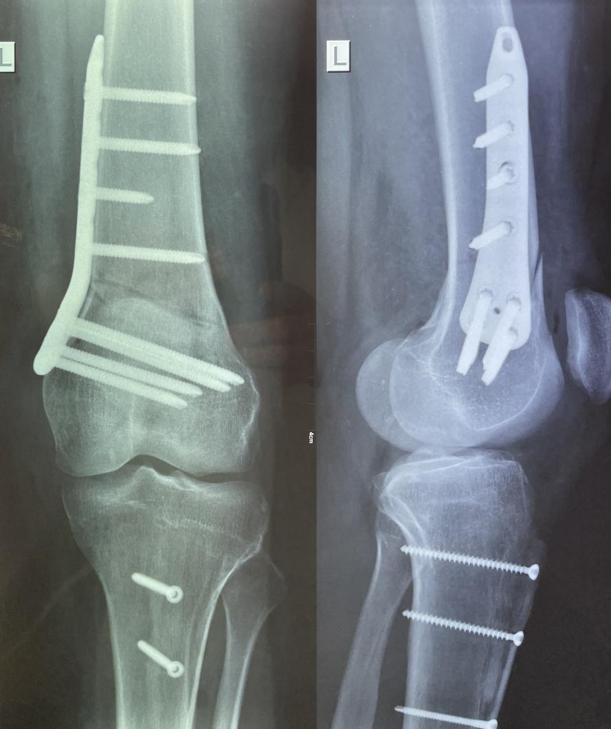 Anterior tibial tubercle osteotomy