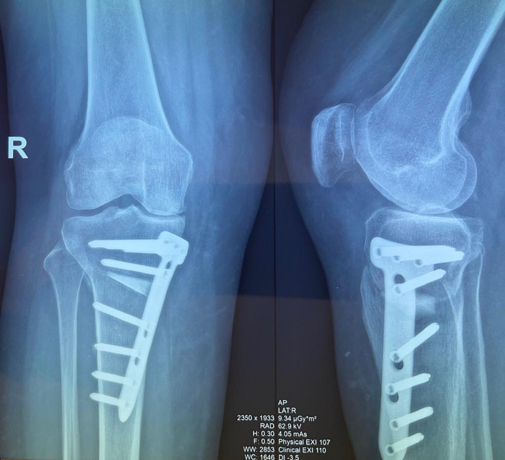 High tibial osteotomy