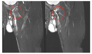 Proximal adductor longus tendon tear