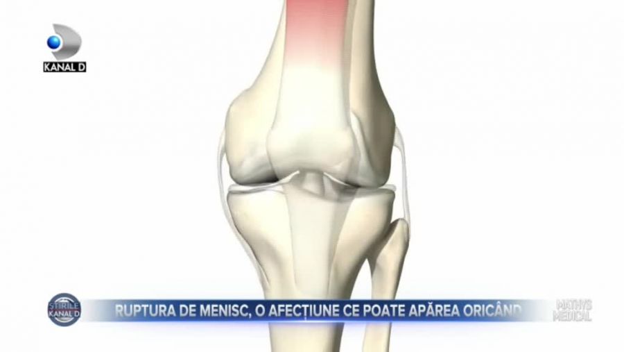 Ruptura de menisc, o afecțiune ce poate apărea oricând
