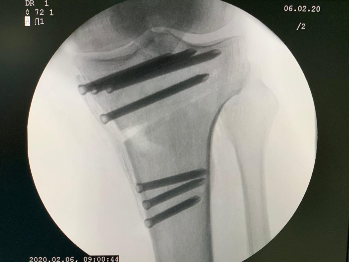 High tibial osteotomy