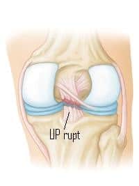 Ruptura de ligamente - Ruperea ligamentului simptomelor articulației umărului și tratamentul