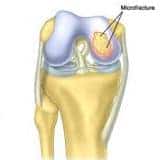 Tratamentul defectului de cartilaj articular