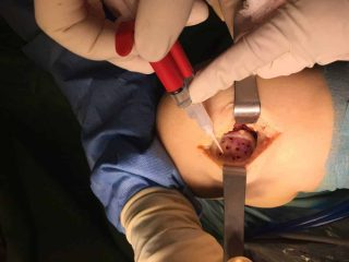 Leziune condril femural implantare fibrin glue