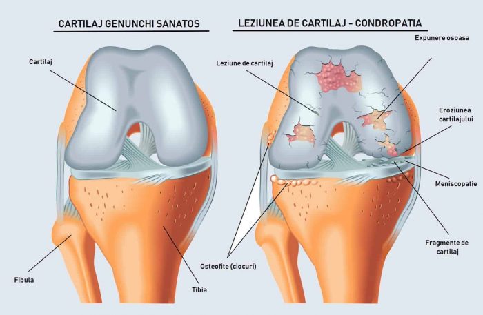 refacerea cartilajului în articulația umărului