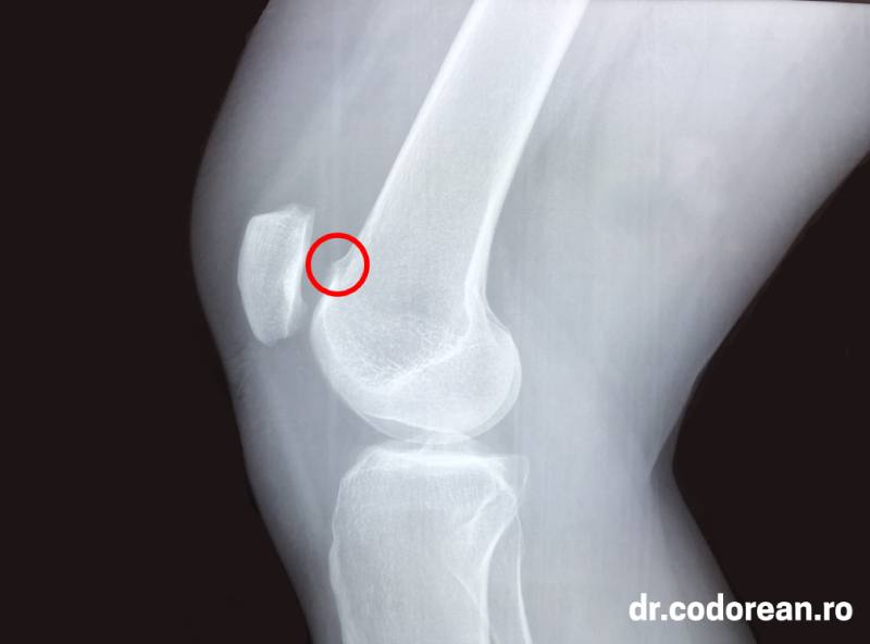 dureri la genunchi la ridicarea piciorului de ce doare articulația genunchiului